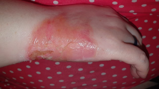 Foto meiner rechten Hand eine Woche nach Verbrühung. Rote Haut auf dem halben Handrücken und der Handkante, teilweise offene Brandblasen, davon eine tiefgehend in untere Hautschichten. Die Haut glänzt durch aufgetragenes Desinfektionsgel.